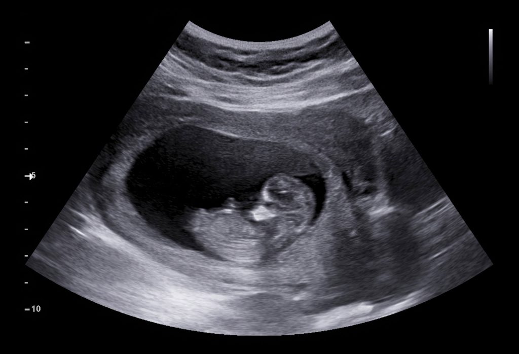 Ultrasound imaging